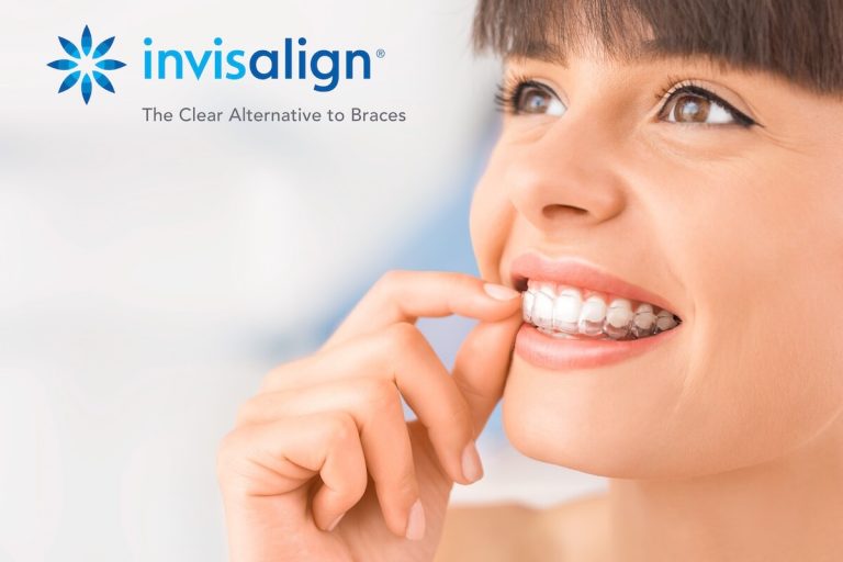 The Benefits of Invisalign: Not Just Popular, It’s the Picture Perfect ...